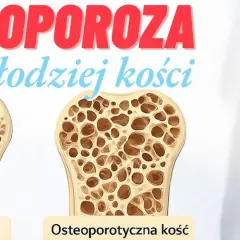 Osteoporoza - cichy złodziej kości. Porównanie zdrowej i osteoporotycznej kości. Szkielet z zaznaczonym bólem w obrębie barku.
